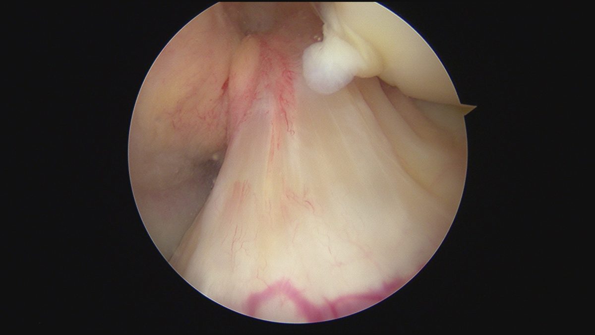 vue arthroscopique du lca