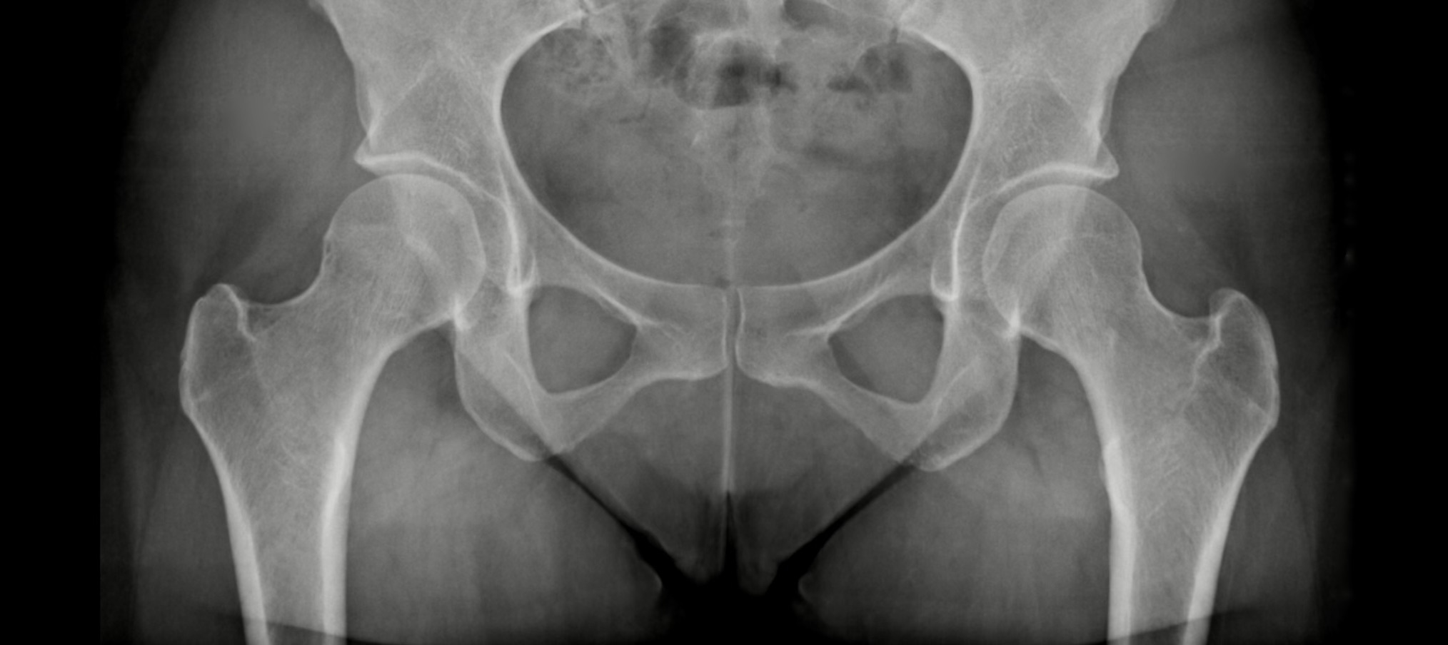 coxarthrose pth perigueux